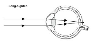Long sighted diagram from Optique, opticians in Battersea