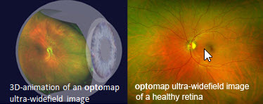 Optomap Eye Examination by Optique - Opticians in Battersea