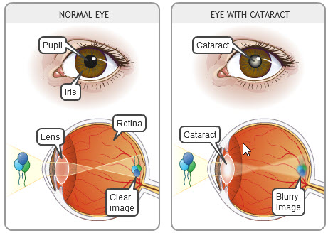 Cataracts - Normal and Eye with Cataracts - Optique, opticians in Battersea