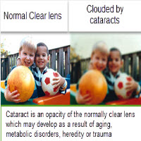 Cataracts - Info from Optique, opticians in Battersea