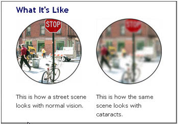 Cataracts - What is it like from Optique - opticians from Battersea