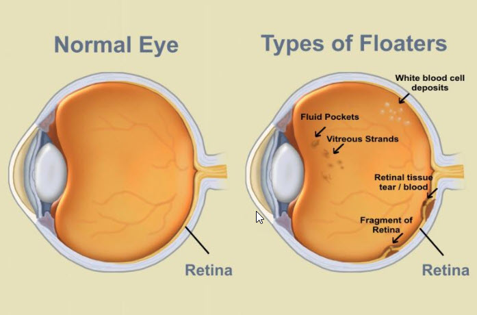 Flashers and Floaters - Info from Optique, opticians in Battersea