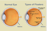 Flashers and Floaters - Info from Optique, opticians in Battersea