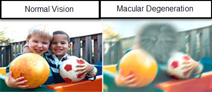 Macular Degeneration - Info by Optique, opticians in Battersea