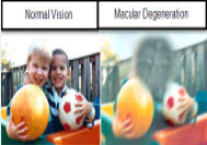 Macular Degeneration - Info from Optique, opticians in Battersea