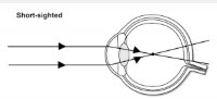 Myopia - Short Sightedness