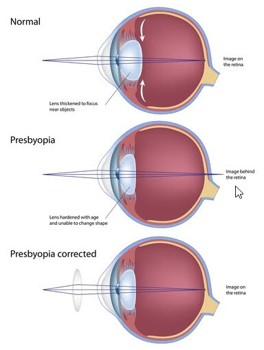 Presbyopia - Info from Optique, opticians in Battersea