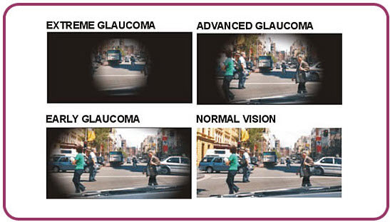 Stages of Glaucoma - Info from Optique, opticians in Battersea