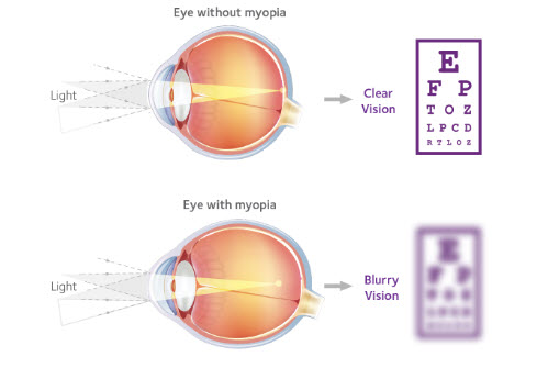 Myopia Management - Optique Opticians in Battersea